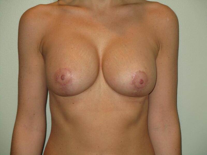 Breast Implant Revision with Lift Before & After Image